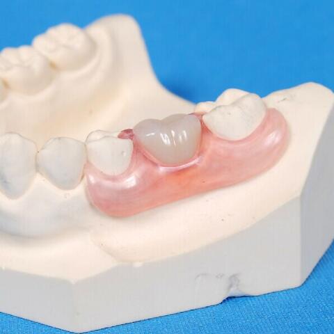 氮化硼补牙材料 氮化硼补牙材料